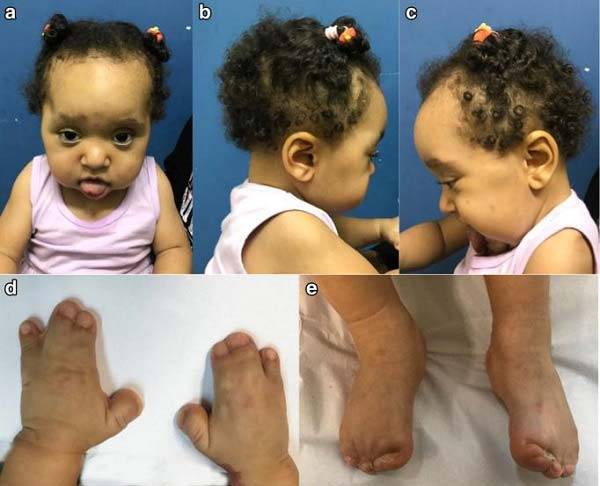 에이퍼트 증후군 때문에 머리가 비정상적으로 위로 뾰족하게 솟은 모습과 손발가락이 붙음 모습/사진=Journal of Rare Diseases