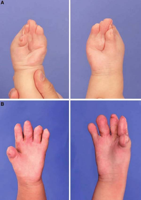 손가락이 붙었던 에이퍼트 증후군 환자 모습(위)과 수술받은 모습(아래)​/사진=Plastic and Reconstructive Surgery