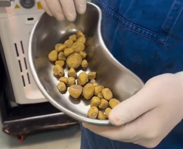 브라질의 한 60대 남성이 탄산음료를 즐겨 마시다가 방광에서 수십 개의 결석이 발견돼 사연이 공개돼 화제다. 니드투노우