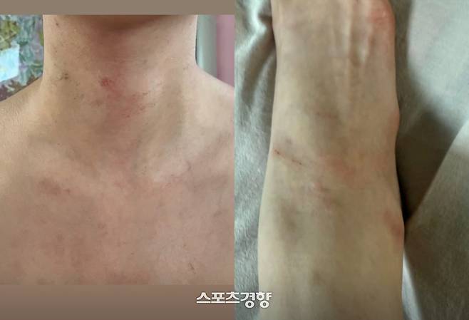 A씨가 전호준으로부터 폭행을 당했다고 공개한 신체 일부 사진. 본인 인스타그램 계정