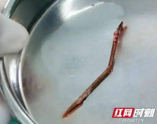 [서울=뉴시스]중국의 한 50대 남성이 몇 주째 지속된 고열과 가슴 통증으로 병원을 찾았다가, 폐 속에서 이쑤시개가 발견되는 황당한 일이 벌어졌다.(사진=홍왕) *재판매 및 DB 금지