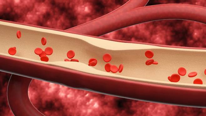 끈적한 혈전에 세균을 달라붙게 해 혈액 속 세균을 제거하는 기술이 개발됐다. 항생제 내성 세균까지 제거할 수 있어 패혈증과 같은 치명적인 전신 감염 치료법 개발에 도움이 될 전망이다. 게티이미지뱅크 제공