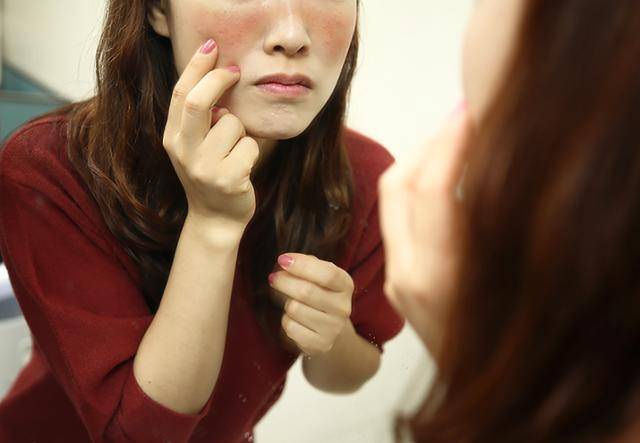 자가면역질환의 일종인 루푸스 환자. 한국일보 자료사진