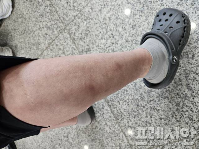 ▲26일 광주 광산구 금호타이어 공장 인근 아파트 주민 김정숙씨가 화재 이후 피부 간지러움과 변색이 생긴 다리를 보여주고 있다.2025.05.26ⓒ프레시안(김보현)