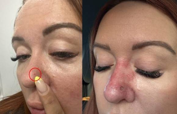 콧등에 생긴 붉은 점을 방치했다가 피부암 진단을 받은 영국 여성. SNS 캡처