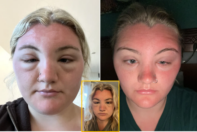 햇빛 때문에 얼굴이 ET처럼 변한 여성의 사연이 공유됐다.[사진=SNS]