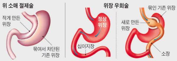 주요 비만대사 수술 종류./사진=조선일보 DB