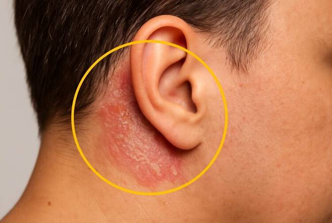 샤워 중 무심코 지나치기 쉬운 부위, '귀 뒤'가 심각한 감염의 온상이 될 수 있다는 피부과 전문의의 경고가 나왔다. [사진=AI 생성 이미지]