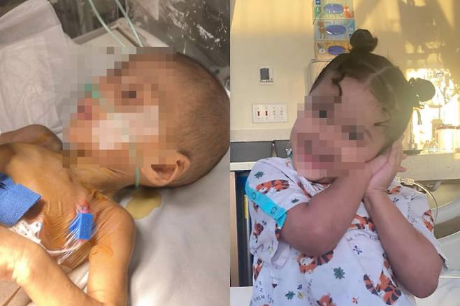 미국에서 치료를 받고 건강을 회복한 멕시코 출신 소녀 소피아(가명). 왼쪽은 지난 2023년 미국에 도착해 병원으로 이송됐을 당시, 오른쪽은 현재 건강을 회복한 모습이다. 사진=LA 타임스/고펀드미 캡처