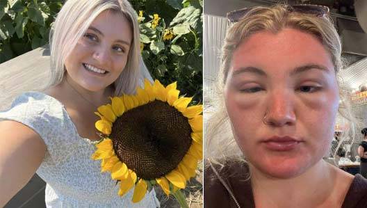 외국의 한 20대 여성이 휴가 중 햇볕을 오래 쬐었다가, 화상을 입어 얼굴이 퉁퉁 부어오른 사연이 공개됐다./사진=더 미러