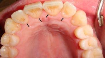 삽 모양 치아./사진=Journal of Dental Sciences