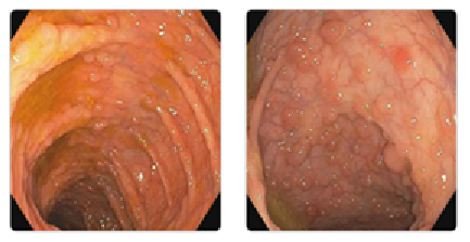 대장내시경 검사에서 발견된 대장 용종의 모습. 국가건강정보포털 제공