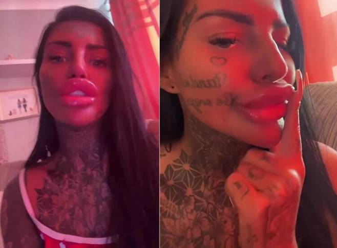 필러 시술 후 입술이 코에 닿을 듯한 모습으로 변한 미국 여성 사연이 공개됐다. [사진=SNS]