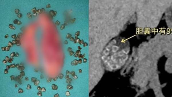 중국의 한 40대 여성이 고지방식을 즐겨 먹다가 수십 개의 담석이 발견된 사연이 공개됐다./사진=머스트쉐어뉴스 캡처