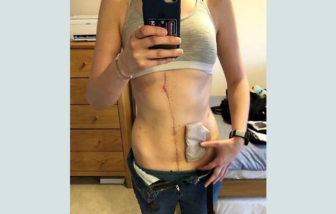 [서울=뉴시스] 영국에 거주하하는 레베카 힌드(39·여)는 복막가성점액종을 진단받고 장기 13개를 제거하는 수술을 받았지만, 병은 완치되지 못했고 결국 불치병 판정을 받았다. (사진=더 미러 캡처) 2025.06.02 *재판매 및 DB 금지