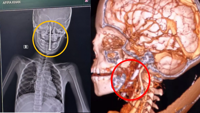 인도 우타르프라데시 주 발람푸르 지역에서 한 7세 남자아이가 놀다가 못 위에 넘어지는 사고를 당해 뇌에 못이 박히는 중상을 입고 기적에 가깝게 살 수 있었던 사례가 공개됐다.[사진= 인도 킹 조지 의과대학 외상외과]