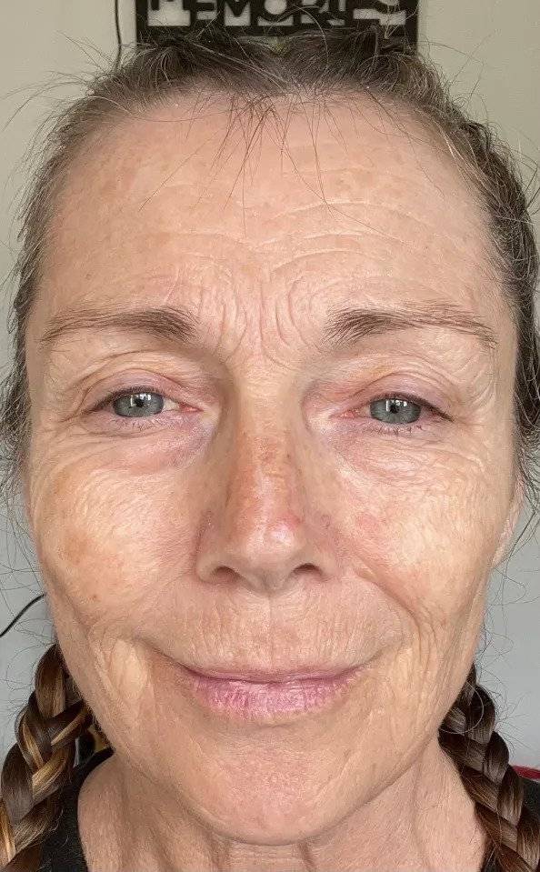 1995133292_VXUaWBkr_yQGjAs0qfg3MLDuC.webp.ren.jpg 레이저 시술 전 후