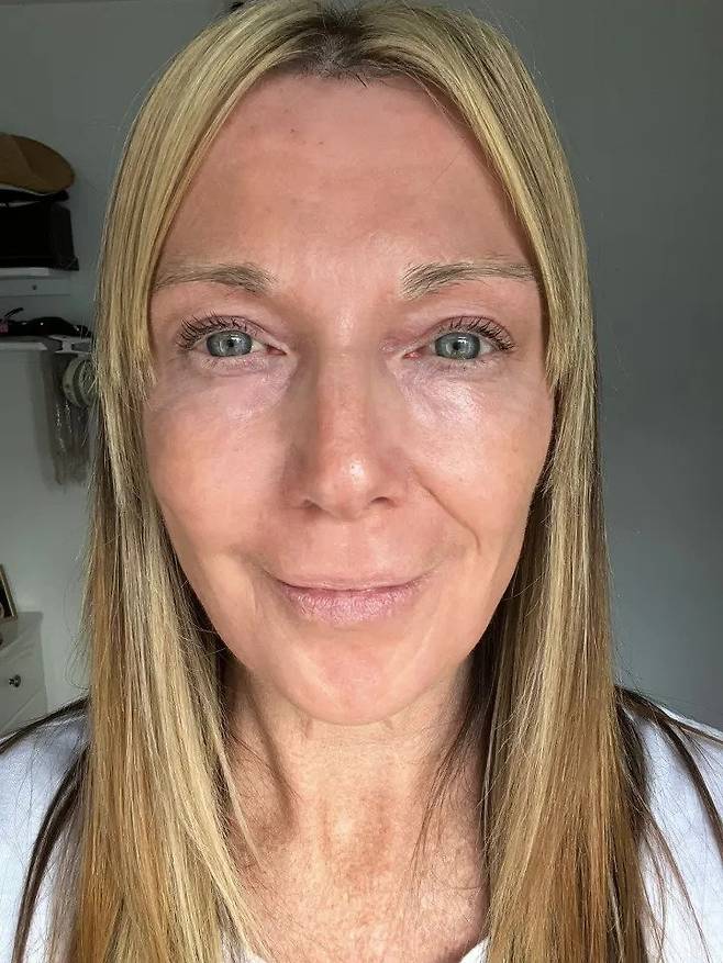 1995133292_Ezgus5el_VLwO3WxbUaIpmjno.webp.ren.jpg 레이저 시술 전 후