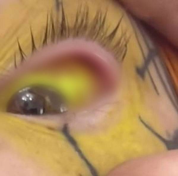 캐나다의 한 여성이 눈동자 문신을 받은 후 부작용을 겪고 있다고 밝혀 화제다./사진=니드투노우