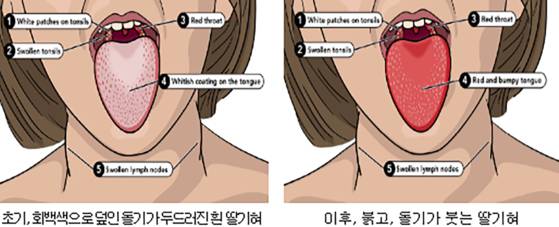성홍열 질병 주요증상 중 혀 부분. 처음에는 회백색이 덮이고 돌기가 현저히 두드러지는 모양에 발병 후 2~3일 지나면 붉은색을 띠고 돌기가 붓는 딸기 모양으로 새빨간 혀가 된다. 질병관리청