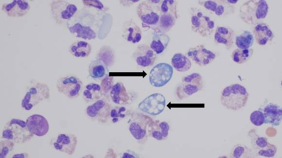 뇌척수액 내 ‘파울러자유아메바’(Naegleria fowleri)의 모습. 미국 질병통제예방센터(CDC) 홈페이지 캡처