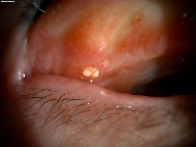 결막결석 환자의 눈 모습. 정근안과병원 제공