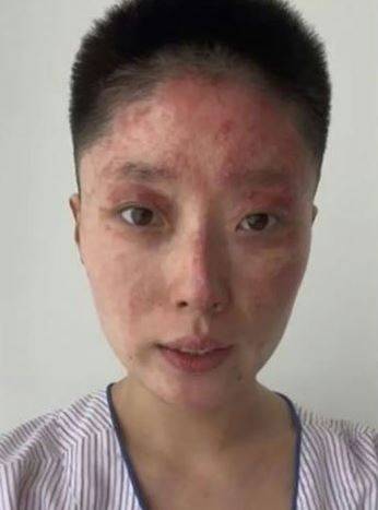 화재 사고를 당한 후 화상을 입은 통야오./사진=지우파이신문