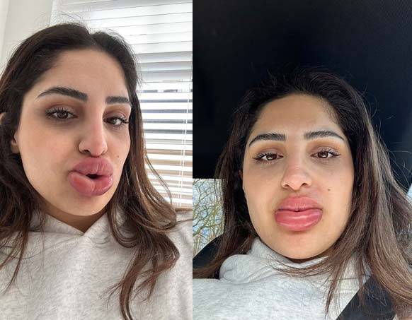 네덜란드의 24세 키미아 아와지는 입술 필러 제거 시술 후 입술이 심하게 부어오르는 부작용을 겪었다고 전했다./사진=데일리메일 캡처