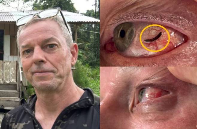 인도네시아를 여행하던 영국 남성의 눈에서 거머리가 발견된 사연이 전해져 충격을 주고 있다. [사진=SNS]