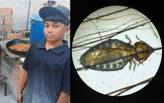 멕시코의 한 12세 소년이 머릿니로 인한 감염으로 패혈성 쇼크와 간부전이 발생해 끝내 사망하는 안타까운 일이 발생했다. *오른쪽 이는 이해를 돕기 위함. [사진=코아우일라 모자병원의 병원/ 머릿니=게티이미지뱅크]