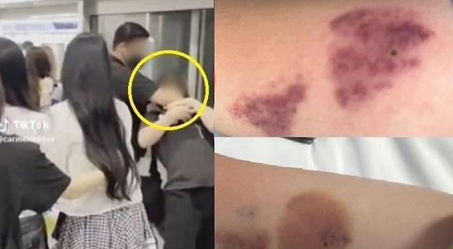 걸그룹 하츠투하츠 경호원이 공항에서 시민을 저지하고 있다(왼쪽), 피해자가 전치 4주 진단을 받았다고 피해를 호소했다. 출처=SNS