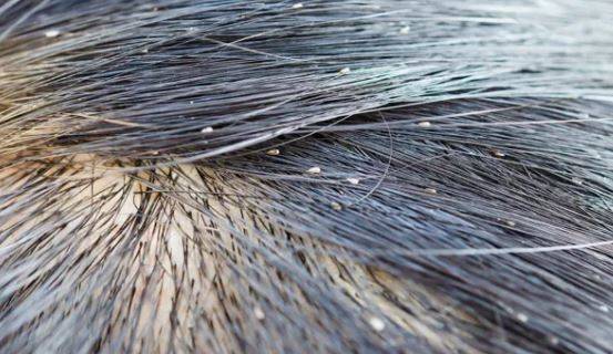 멕시코의 한 10대 소년이 머릿니 감염으로 사망한 충격적인 사연이 공개돼 화제다. 사진은 기사 사례와 무관함./사진=British Journal of Community Nursing