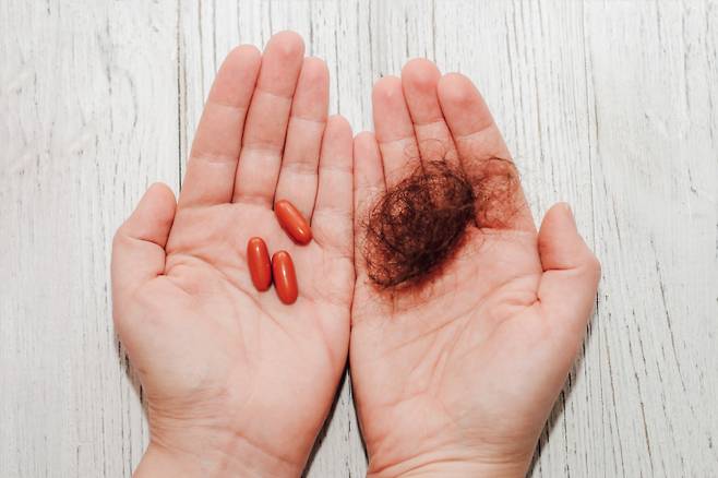 최근 원형탈모를 호소하는 20~40대 젊은 환자가 증가하며 탈모 치료제 급여화에 대한 관심이 높아졌다. 게티이미지뱅크