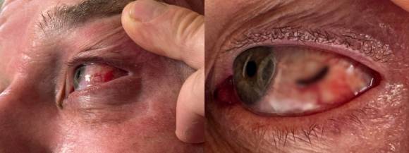 인도네시아 여행 중 눈에서 거머리를 발견한 영국 남성 토니 엑솔. 토니 엑솔 페이스북 캡처