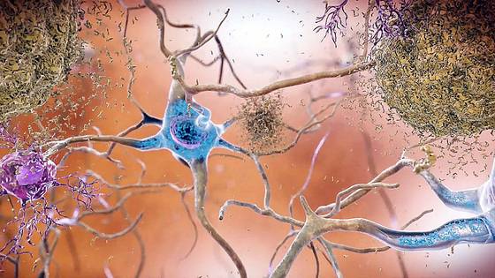 알츠하이머병의 환자의 뇌에선 베타 아밀로이드 찌꺼기와 타우 단백질 엉킴이 관찰된다 문제는 이 증상이 관찰되는 사람들이 모두 병에 걸리지는 않는다는 것이다. 즉 이게 알츠하이머병이 원인인지 결과인지가 여전히 불분명하다. 사진 알츠하이머 펀드