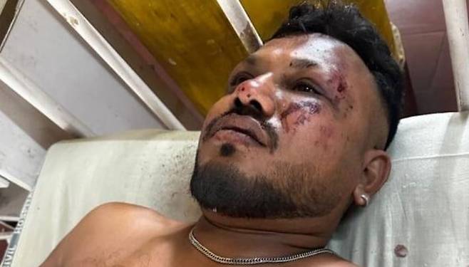 인도 여객기 추락 사고 생존자인 비슈와시 쿠마르 라메시가 병원으로 옮겨져 치료받고 있다. /힌두스탄 타임스 보도화면