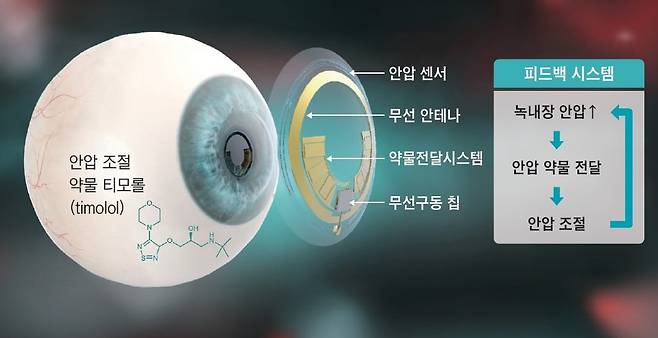 녹내장 환자의 안압 모니터링 및 안압 조절 약물 전달 피드백 시스템 모식도./자료=포스텍