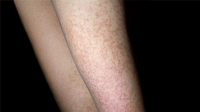 모공각화증은 주로 어린이와 청소년에게서 주로 나타나며, 나이가 들면서 자연스럽게 호전되는 경우가 많다｜출처: 클립아트코리아