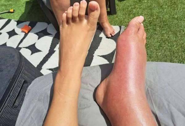 케이틀랜드 라이트(26)의 오른쪽 다리가 부어올랐을 때 모습./사진=더 미러