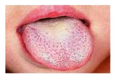 성홍열에 특징적 증상 중 하나인 '딸기 혀'의 모습./사진=부산시감염병관리지원단, 위키피디아