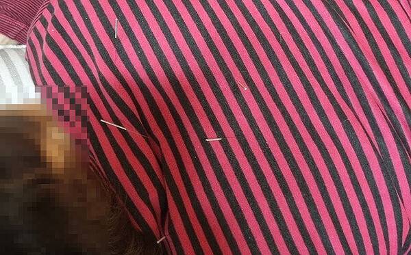 ㄱ씨가 피해자의 옷 위로 침을 놓다 적발된 모습. 사진=제주자치경찰단