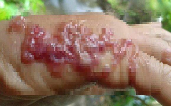 태국의 한 남성이 야외에서 잡초를 제거하던 중 피부에 기생충이 침투해, 손에 물집이 무더기로 생긴 사연이 전해졌다. 출처=페이스북