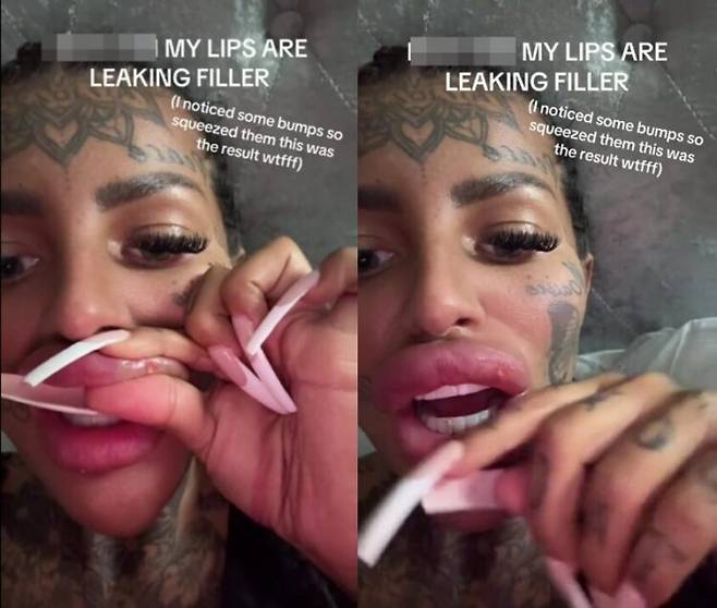 반복적인 필러 시술로 부풀린 입술에서 실제로 필러가 새어나오는 현상을 겪은 여성이 이를 SNS에 공개했다. [사진=SNS]