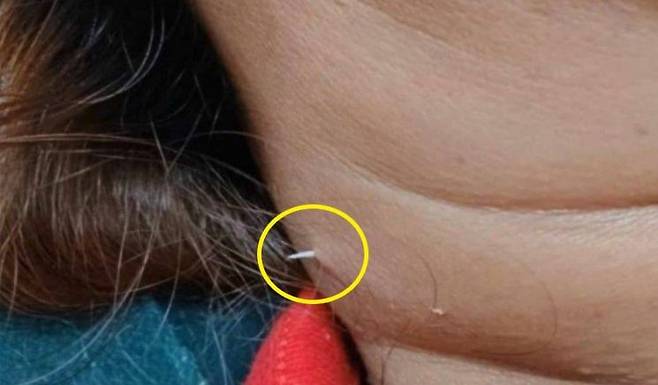 피부를 뚫고 밖으로 나온 생선 가시의 모습. 페이스북 캡처