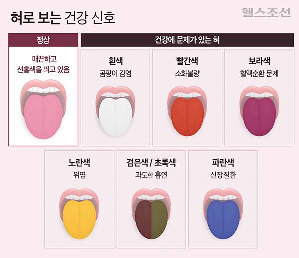혀 색으로 관련 질환을 추정할 수 있다./그래픽=최우연​