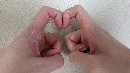 폐 건강은 검지 손톱을 맞대 누르는 '샴로트의 창문 테스트'로 가늠할 수 있다./사진=강동성심병원