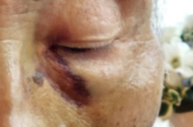 얼굴 부위 피멍 [독자 제공. 재판매 및 DB 금지]