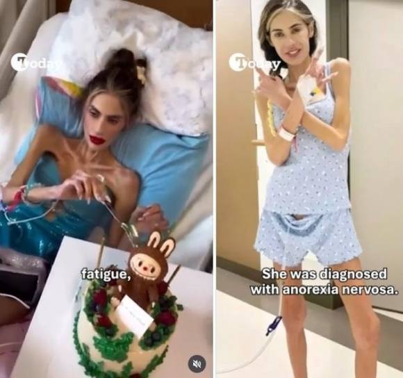 튀르키예 인플루언서 니할 칸단(30)이 심각한 거식증을 앓다가 사망했다. SNS 캡처