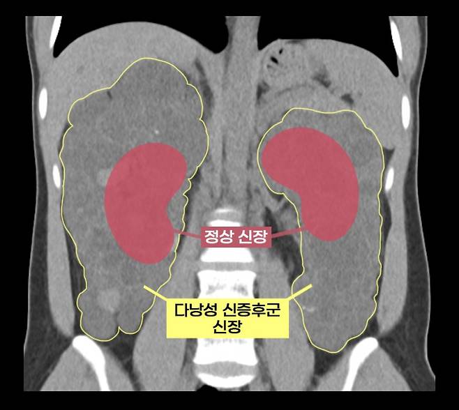 다낭성 신증후군 환자의 신장과 정상 신장 비교. 다낭성 신증후군 환자의 신장은 수많은 낭종으로 울퉁불퉁하고 크기도 비대해진다. 서울아산병원 제공.