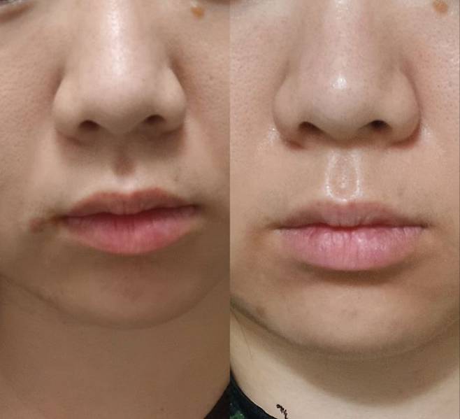 제품 사용 전(왼쪽)과 후(오른쪽) 사진. 팔자주름이 개선됐다. ⓒ데일리안 남가희 기자